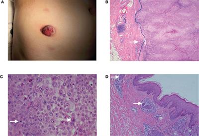 Axillary lymph node dissection combined with radiotherapy for trichilemmal carcinoma with giant lymph node metastasis: A case report